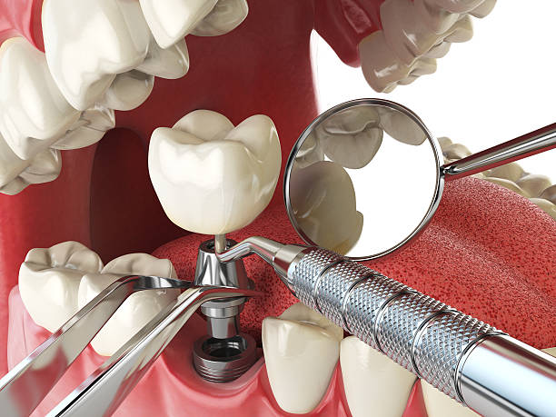 Best Emergency Dental Care for Broken or Chipped Teeth in Kingston, IL